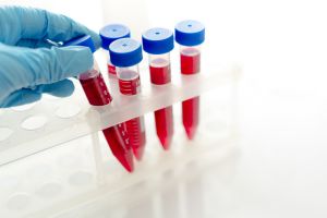 Anemia