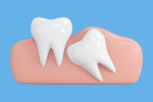 Dentes do siso incluso semi incluso