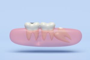 Dentes do siso nao rompem na totalidade