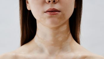 Vitiligo nao segmentar Agilcare