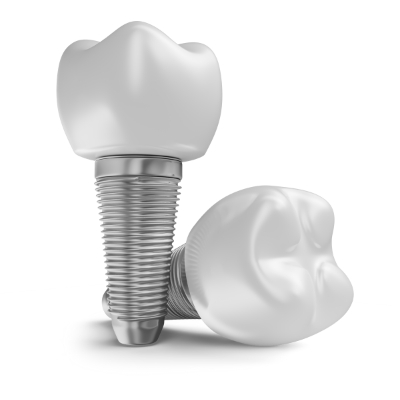 Prótese ou Implante: qual a diferença? Implante Dentario Agilcare