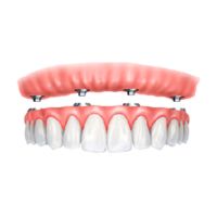 Prótese ou Implante: qual a diferença? Protese Fixa sobre 4 implantes Agilcare