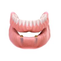 Prótese ou Implante: qual a diferença? Protese removivel sobre 2 implantes