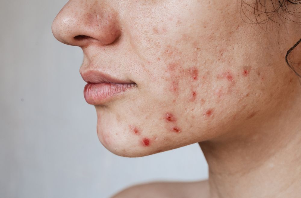 Acne: o que é e como tratar?