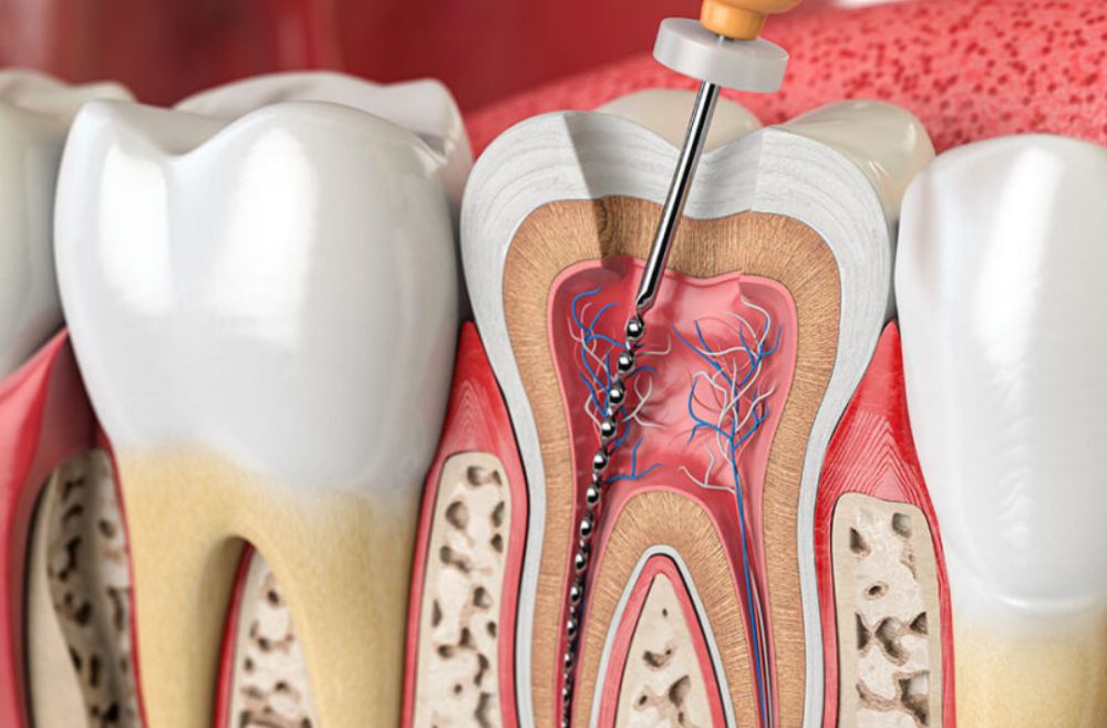 O que é uma desvitalização dentária?