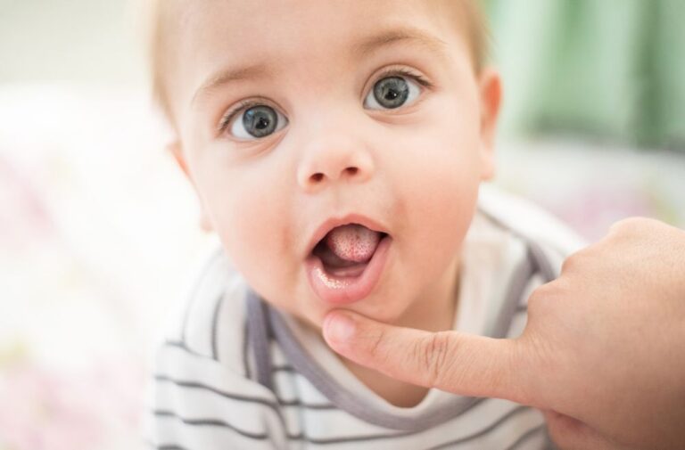 Sapinhos no bebé: como tratar a candidíase oral - Agilcare | Plano de ...