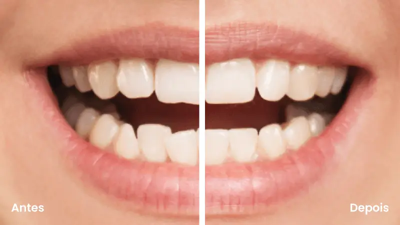 Alinhadores invisíveis agilcare plano de saude e dental