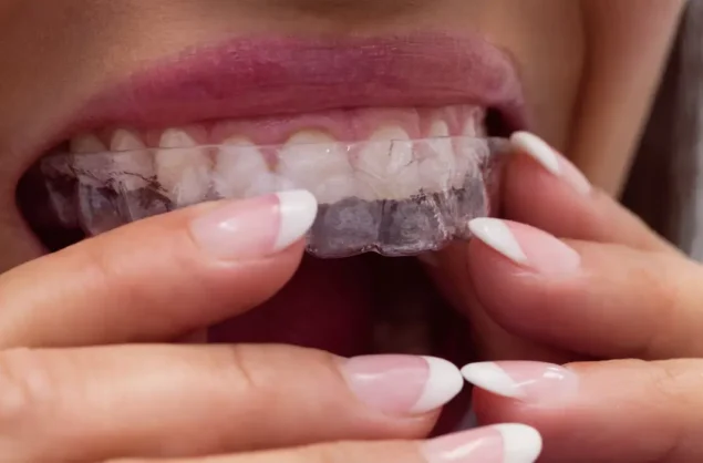 Alinhadores Invisíveis quanto tempo dura o tratamento Agilcare Plano de Saúde + Plano Dental