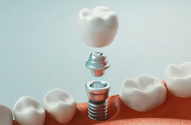 Implante dentário: como funciona, quanto custa e o que esperar