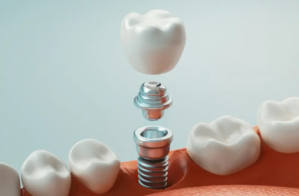 Implante dentário: como funciona, quanto custa e o que esperar